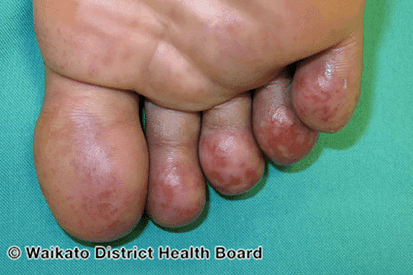Rencic | chilblains-1